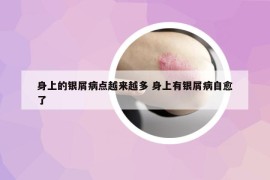 身上的银屑病点越来越多 身上有银屑病自愈了