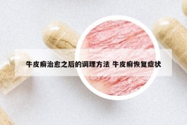 牛皮癣治愈之后的调理方法 牛皮癣恢复症状