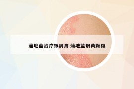 蒲地蓝治疗银屑病 蒲地蓝银黄颗粒