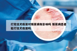 打完狂犬疫苗对银屑病有影响吗 银屑病患者能打狂犬疫苗吗