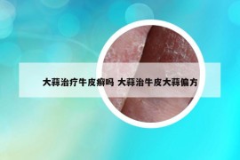 大蒜治疗牛皮癣吗 大蒜治牛皮大蒜偏方