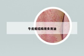 牛皮癣结痂用食用油