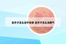 坐月子怎么治牛皮癣 坐月子怎么治脚气