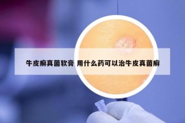 牛皮癣真菌软膏 用什么药可以治牛皮真菌癣