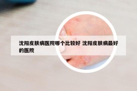 沈阳皮肤病医院哪个比较好 沈阳皮肤病最好的医院