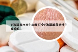 兴城温泉水治牛皮癣 辽宁兴城温泉能治疗牛皮癣吗