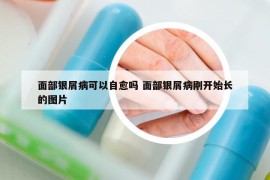 面部银屑病可以自愈吗 面部银屑病刚开始长的图片