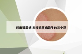 印度银屑病 印度银屑病最牛的三个药