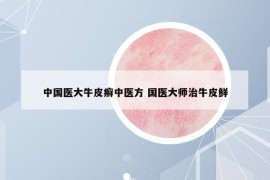 中国医大牛皮癣中医方 国医大师治牛皮鲜