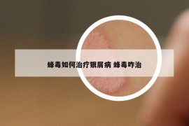 蜂毒如何治疗银屑病 蜂毒咋治