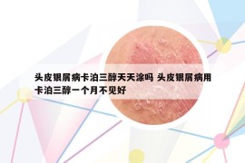 头皮银屑病卡泊三醇天天涂吗 头皮银屑病用卡泊三醇一个月不见好
