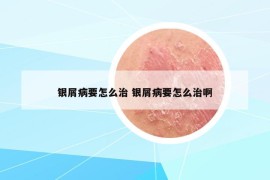 银屑病要怎么治 银屑病要怎么治啊
