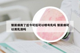 银屑病用了适今可后可以喂母乳吗 银屑病可以用乳液吗