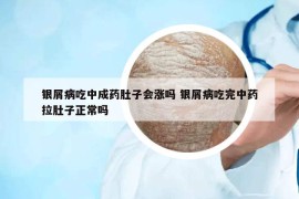 银屑病吃中成药肚子会涨吗 银屑病吃完中药拉肚子正常吗