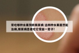 常吃哪种水果预防银屑病 这四种水果居然能治病,银屑病患者吃它受益一辈子!