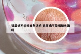 银屑病不能喝鲫鱼汤吗 银屑病不能喝鲫鱼汤吗