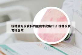 桂林最好皮肤科的医院牛皮癣疗法 桂林皮肤专科医院