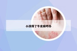 小孩得了牛皮癣咋办
