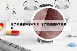 得了银屑病怀孕可以吗 得了银屑病怀孕能要吗
