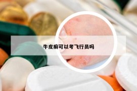 牛皮癣可以考飞行员吗