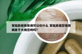 掌跖脓疱银屑病可以吃什么 掌跖脓疱型银屑病属于大病范畴吗?