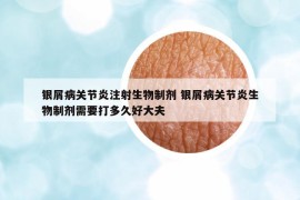 银屑病关节炎注射生物制剂 银屑病关节炎生物制剂需要打多久好大夫