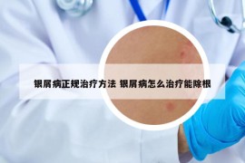 银屑病正规治疗方法 银屑病怎么治疗能除根
