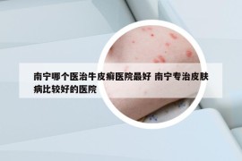 南宁哪个医治牛皮癣医院最好 南宁专治皮肤病比较好的医院