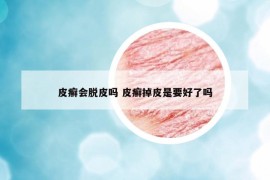 皮癣会脱皮吗 皮癣掉皮是要好了吗