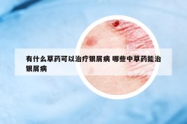 有什么草药可以治疗银屑病 哪些中草药能治银屑病