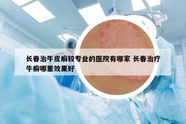 长春治牛皮癣较专业的医院有哪家 长春治疗牛癣哪里效果好