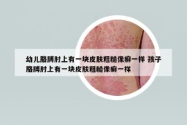 幼儿胳膊肘上有一块皮肤粗糙像癣一样 孩子胳膊肘上有一块皮肤粗糙像癣一样