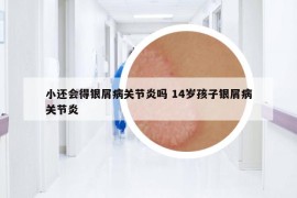 小还会得银屑病关节炎吗 14岁孩子银屑病关节炎