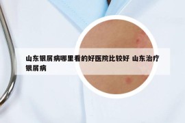 山东银屑病哪里看的好医院比较好 山东治疗银屑病