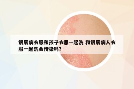 银屑病衣服和孩子衣服一起洗 和银屑病人衣服一起洗会传染吗?