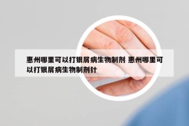 惠州哪里可以打银屑病生物制剂 惠州哪里可以打银屑病生物制剂针