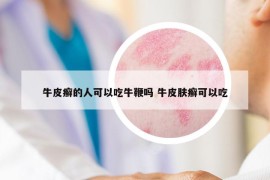 牛皮癣的人可以吃牛鞭吗 牛皮肤癣可以吃