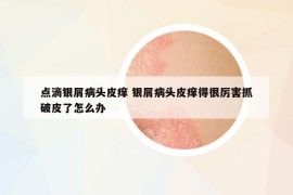点滴银屑病头皮痒 银屑病头皮痒得很厉害抓破皮了怎么办