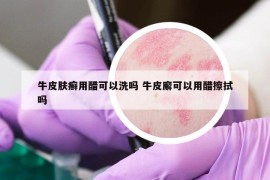 牛皮肤癣用醋可以洗吗 牛皮廨可以用醋擦拭吗