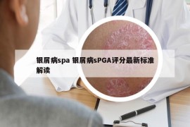 银屑病spa 银屑病sPGA评分最新标准解读