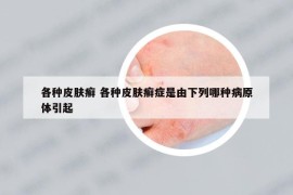 各种皮肤癣 各种皮肤癣症是由下列哪种病原体引起