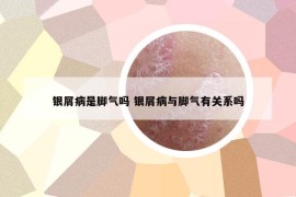 银屑病是脚气吗 银屑病与脚气有关系吗