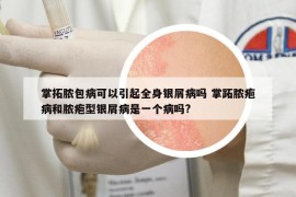掌拓脓包病可以引起全身银屑病吗 掌跖脓疱病和脓疱型银屑病是一个病吗?