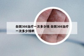 白斑308治疗一次多少钱 白斑308治疗一次多少钱啊