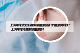 上海哪家皮肤科银屑病医院最好的医院哪家好 上海哪家看银屑病医院好