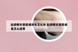 肚脐眼长银屑病渗水怎么办 肚脐眼长银屑病是怎么回事