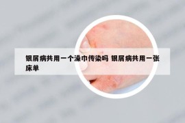 银屑病共用一个澡巾传染吗 银屑病共用一张床单