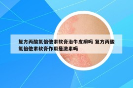 复方丙酸氯倍他索软膏治牛皮癣吗 复方丙酸氯倍他索软膏作用是激素吗