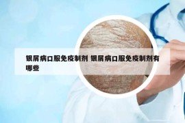银屑病口服免疫制剂 银屑病口服免疫制剂有哪些