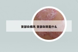 背部白癜风 背部白斑是什么